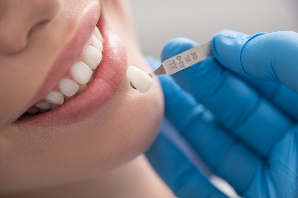 How Dental Crowns Are Used in General Dentistry from Allure Dental of Hollywood in Hollywood, FL