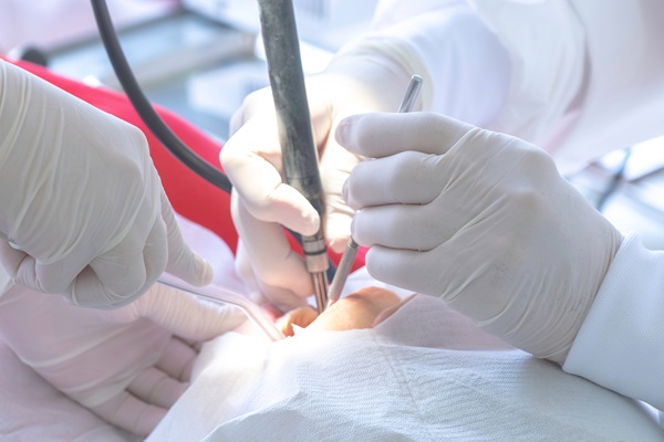 Dental Fillings: Restoring Teeth Affected By Cavities And Decay