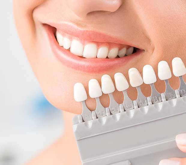 Hollywood Dental Veneers and Dental Laminates