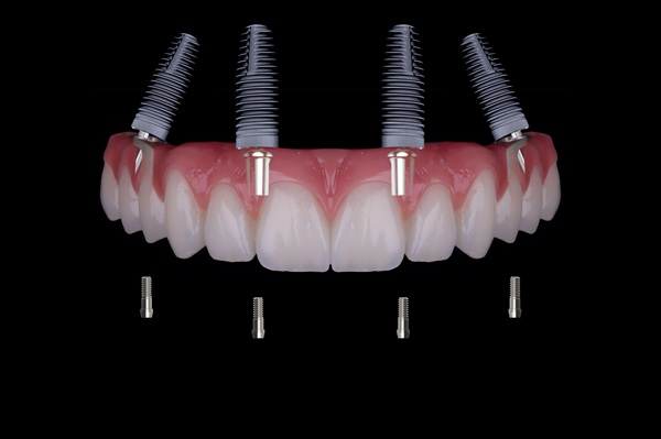 Implant Overdentures: A Secure And Comfortable Alternative To Traditional Dentures