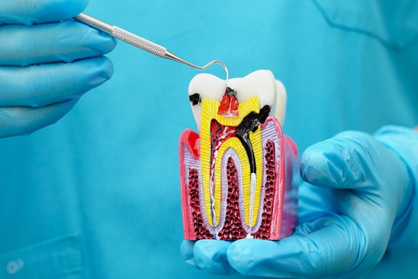 How A Root Canal Can Save Your Tooth